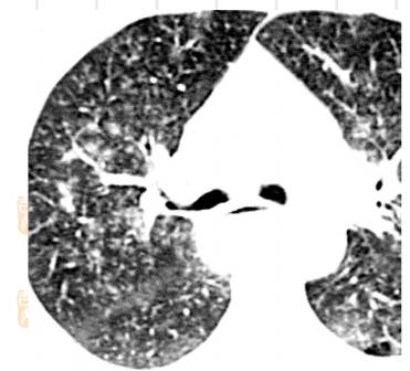 胸部树芽征CT征象,图文详解,必须get!