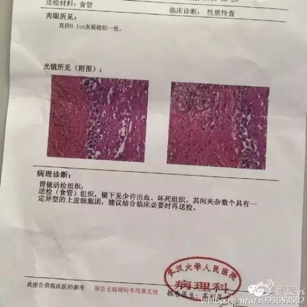 (活检报告)病检结果回来后,结合目前情况,考虑食管癌可能性大,建议请