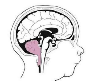 小脑扁桃体下疝畸形临床上如何进行鉴别诊断