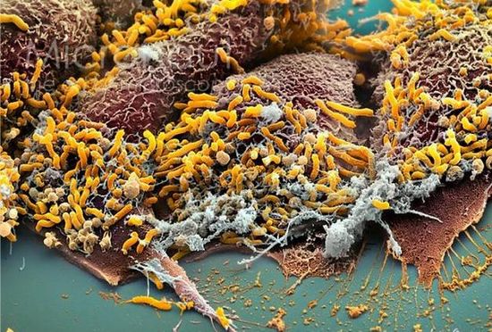幽门螺杆菌能诱发胃癌 幸好食疗能杀死它