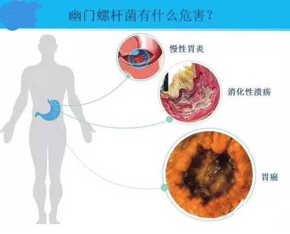 幽门螺杆菌能诱发胃癌幸好食疗能杀死它