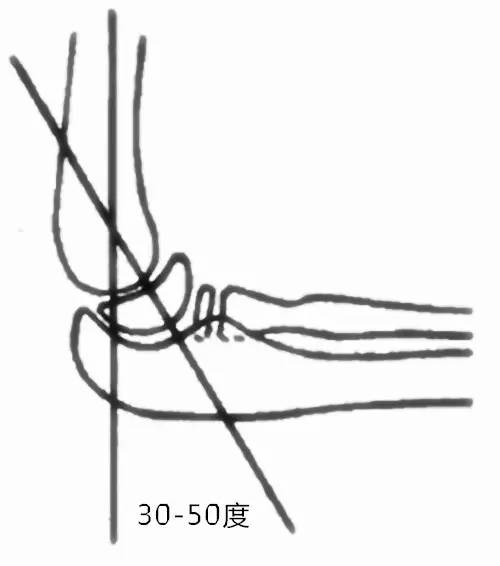 若骨折线穿过骺板,可能影响骨骺的发育,因而常出现肘内翻畸形或肘外翻