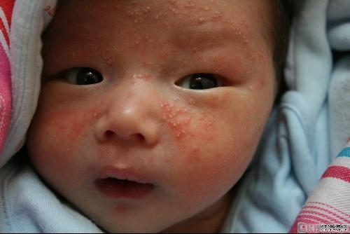 常见问题Q&A --- 帮你快速了解儿童湿疹