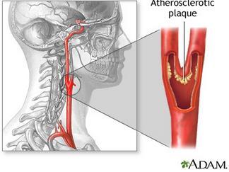 何为颈动脉"斑块"