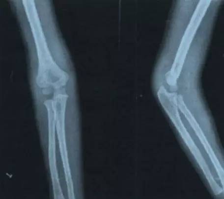 髁上青枝骨折图 9 伸直型肱骨髁上骨折,骨折线水平通过鹰嘴窝或其上方
