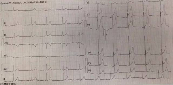 入院当日00 我院急诊心电图