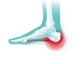 跖趾关节反复屈伸,跖腱膜受到反复牵拉刺激,是导致跟痛症形成及产生