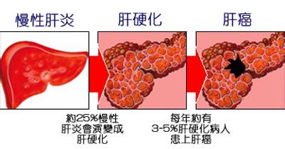 主要是因为肝功能受损,凝血功能异常所导致,它在肝癌合并肝硬化的患者