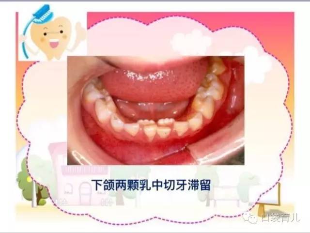 北大口腔儿童牙医讲0-6岁宝宝牙齿护理全攻略!-搜狐
