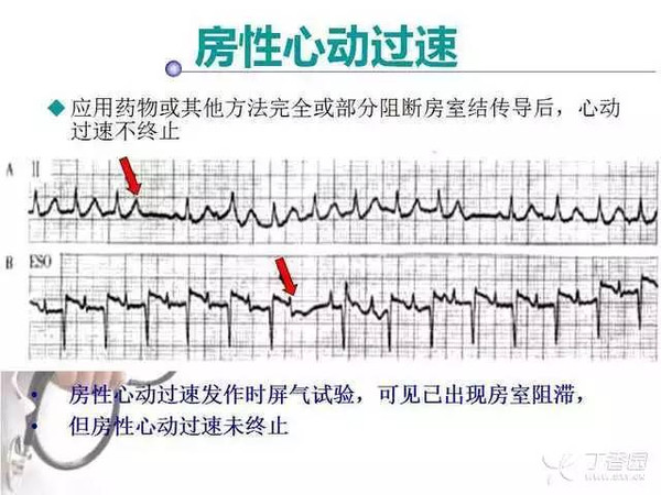 阵发性室上性心动过速的诊断与鉴别