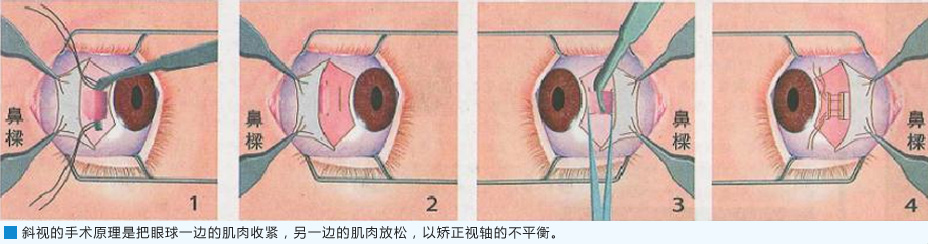 斜视手术有风险及后遗症吗?