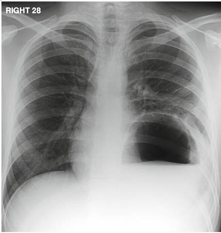 因胸痛,气短1天来诊,胸片如图: 气胸 肺脓肿 气血胸 膈肌破裂 胃穿孔