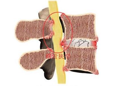 腰椎间盘突出症和椎管狭窄的图解鉴别腰椎间盘