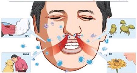 过敏性鼻炎可以用拔罐治疗