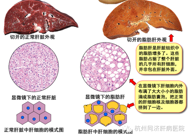 脂肪肝,没想到错误的认识你这么多年