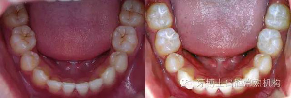 2 )乳磨牙3-4岁, 第一恒磨牙6-7岁, 第二恒磨牙11-13岁, 双尖牙9-13