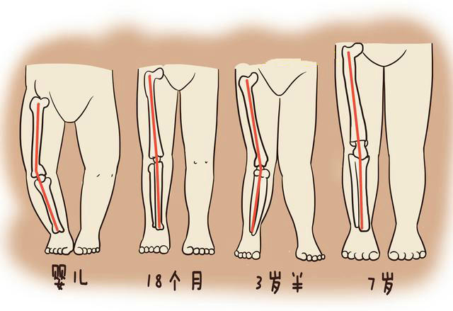 宝宝o型腿?x型腿?要治吗?