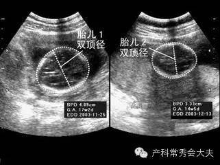 双胎妊娠阴道分娩的临床护理分析