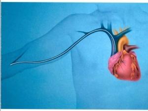 经B超引导颈内静脉置入PICC管在临床中的应