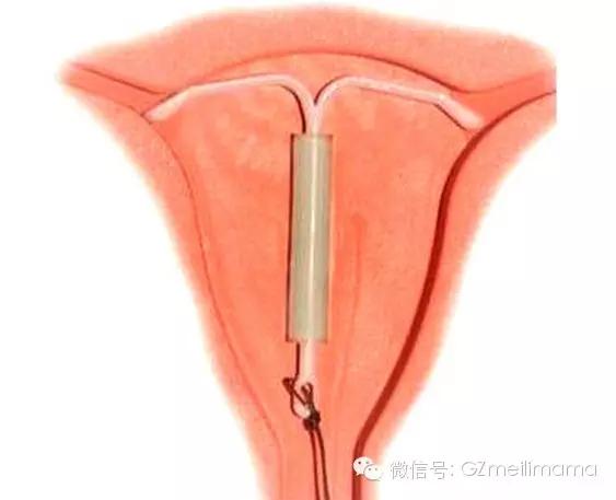 什么是上环,它是一种手术,一种在女性子宫内放置异物,造成子宫永远在