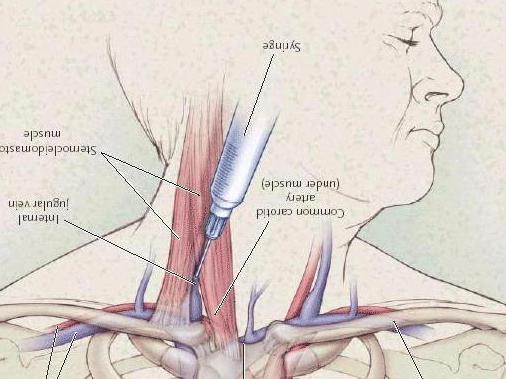 经b超引导颈内静脉置入picc管在临床中的应用