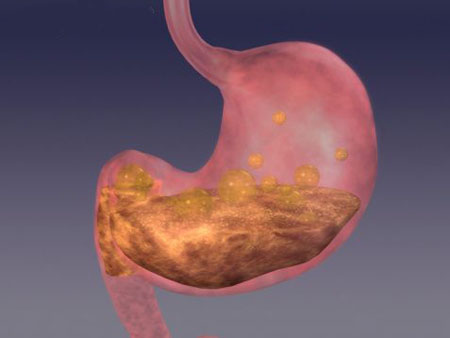 糜烂性胃炎有什么症状?糜烂性胃炎怎么调理?