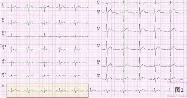 健康 正文 v1,v2导联出现q波或qs波,就是前间壁心梗吗?