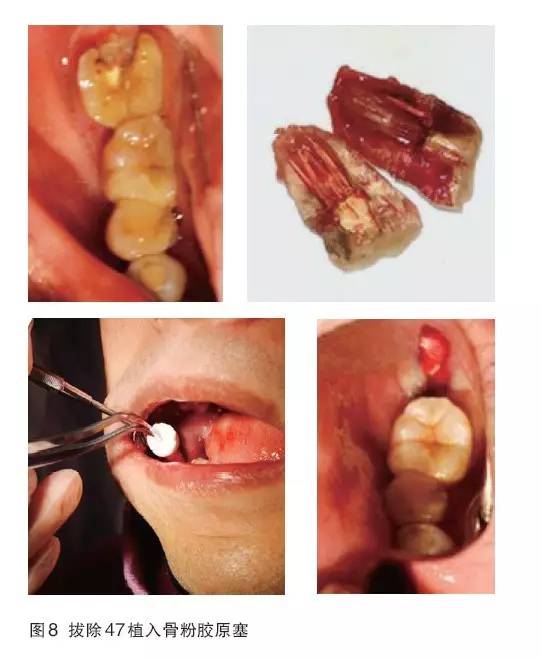 47后,植入骨粉胶原塞(图7~9);3个月后cbct分析骨质;行47种植牙修复术