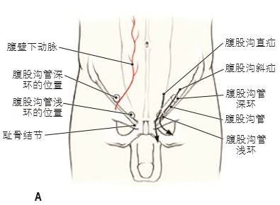 11 腹股沟疝.a 穿经腹壁结构的解剖关系 b.