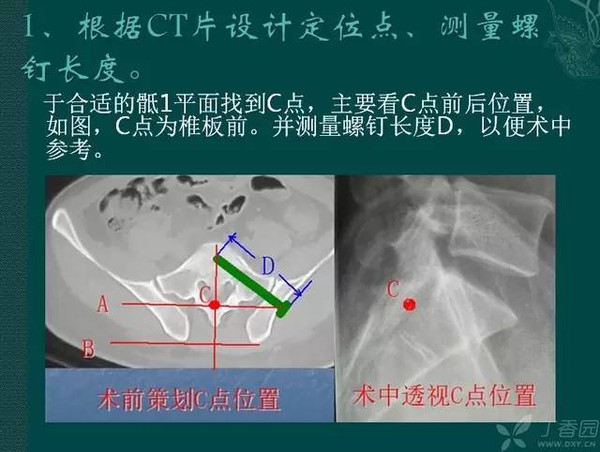 手术技巧:这样打骶髂螺钉更准确