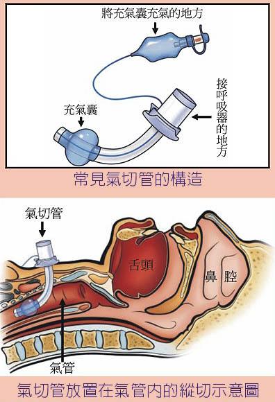 气管切开术打开气道的急救措施