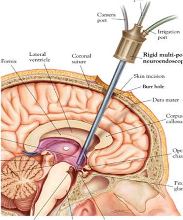 经胼胝体-穹隆间显微及内镜入路的解剖