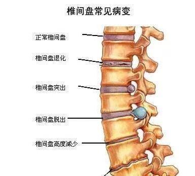 3,在急性期发病期,腰椎间盘突出患者应该采取面朝下的体位俯卧在硬板