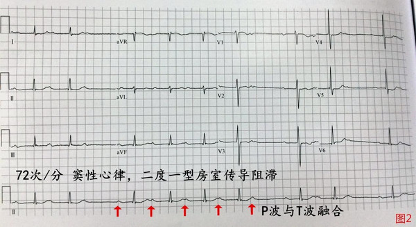 解读房室传导阻滞