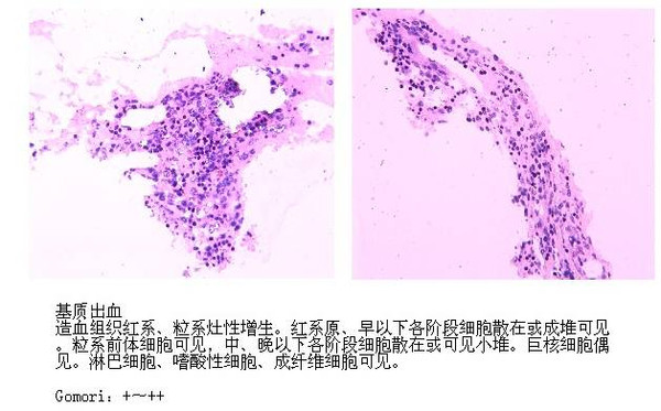 29×104拷贝/ml↑ 骨髓检查 骨髓涂片