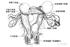 让我们来看一下各种子宫肌瘤的样子,果然这样的子宫很不规整了.