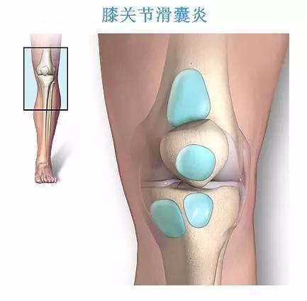 膝关节滑囊炎总复发看看医生怎么解