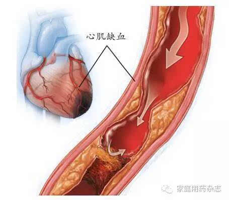 是什么诱发了"心肌缺血"|一分钟科普