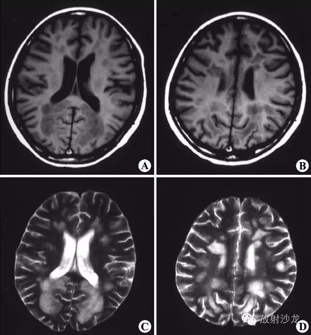 脑白质病变的影像学鉴别诊断