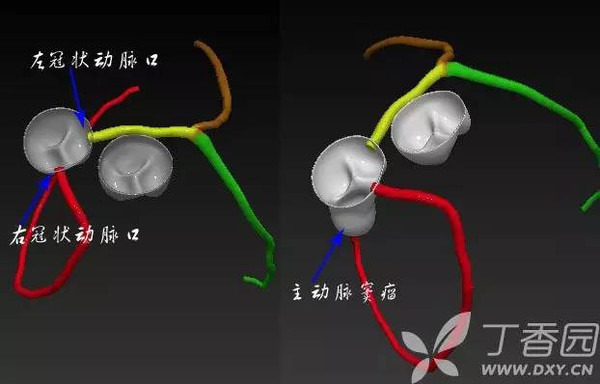 那左冠右冠来自于哪里——他们开口于主动脉的瓣膜,主动脉有 3 个瓣膜