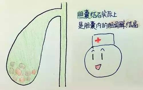 胆囊结石临床路径