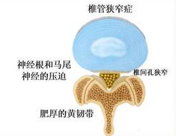 腰椎管狭窄怎么治疗