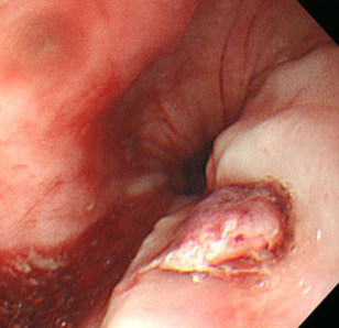 食管距门齿22 cm处见一隆起型病变,表面被有糜烂坏死物质.