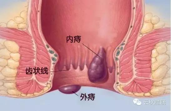 "医生,我的痔疮是公还是母"?