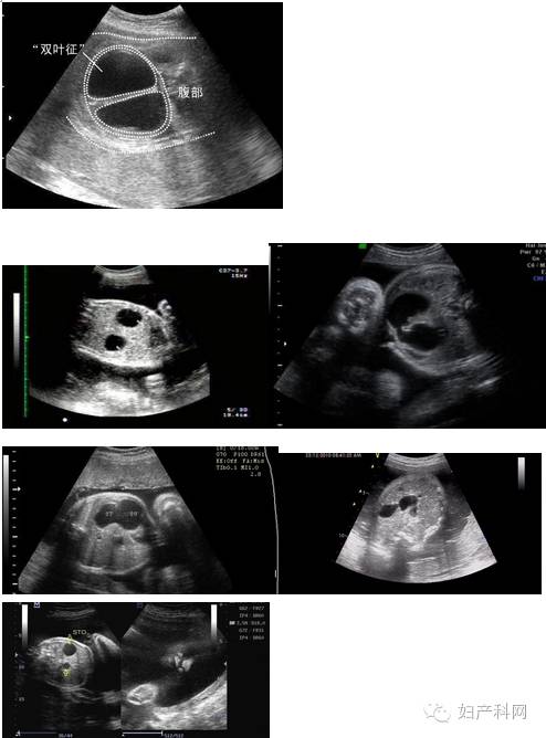 【超声笔记】no.08超声诊断胎儿消化系统畸形(图)