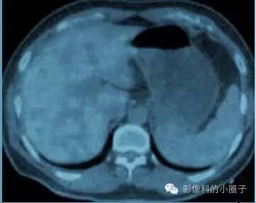若想腹部CT图像好,肠道准备很重要!