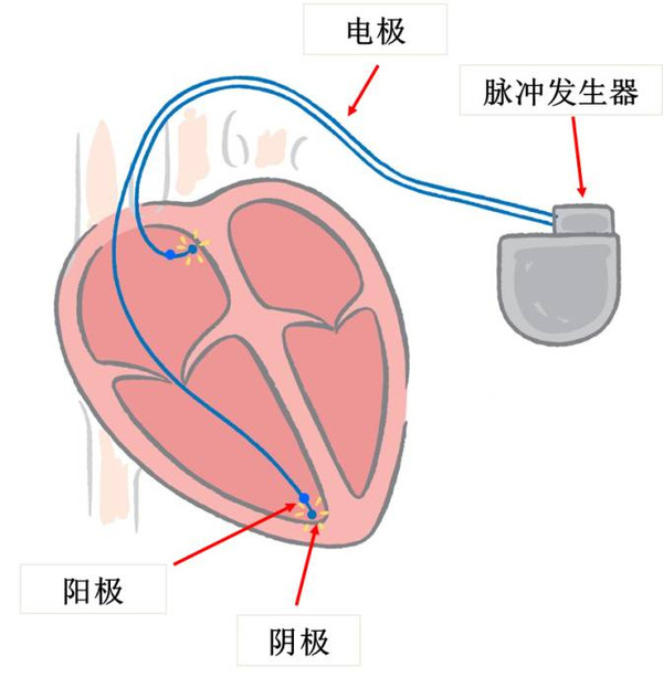 日本起搏器百万人口植入量_心脏起搏器图片