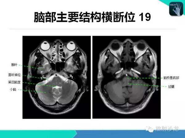 超详细颅脑mri常用解剖