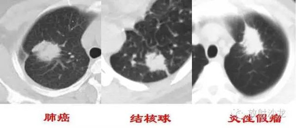 弦距与距长之比>2/5为深分叶;肺癌常见深分叶,错构瘤及结核球可呈浅分