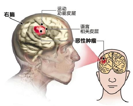 【额叶肿瘤的概述